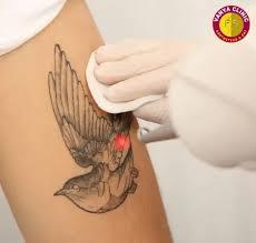 Tattoo Removal